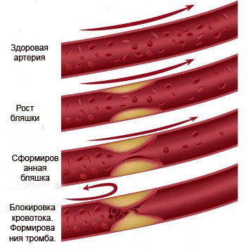 Атеросклероз нижних конечностей