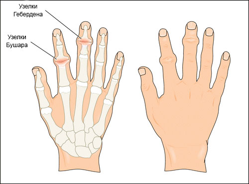 Артроз суставов кистей рук — симптомы и лечение в СПБ