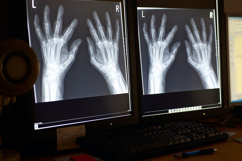 Диагностика артрита кистей рук