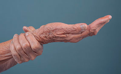Лечение артрита кистей рук