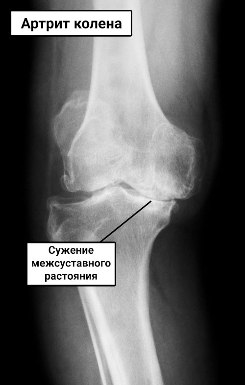 Диагностика артрита путем рентгена суставов