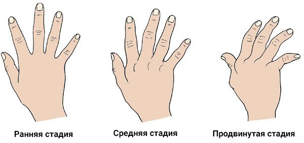 Стадии развития артрита пальцев