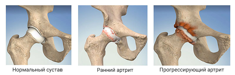 Стадии артрита тазобедренного сустава