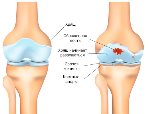 Артроз 1 степени коленного сустава: лечение