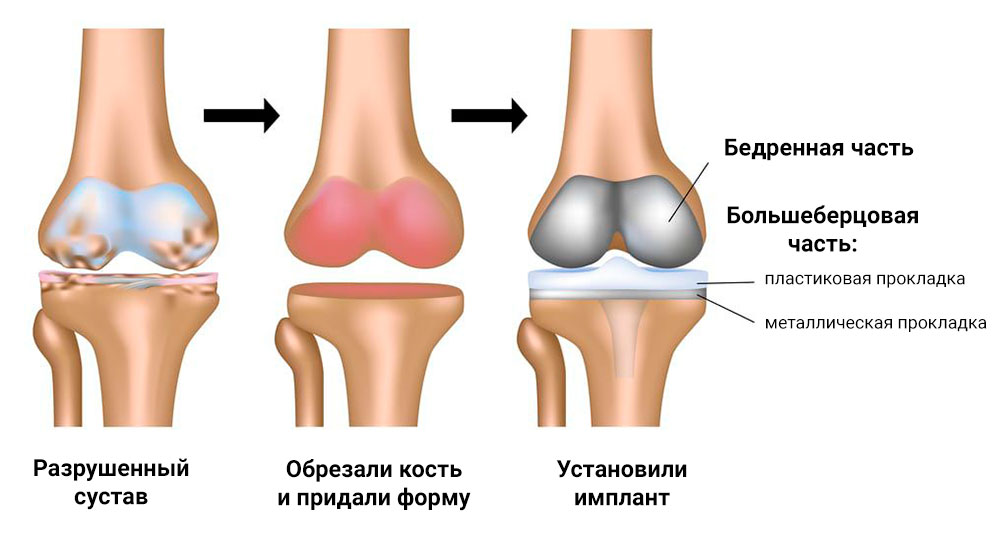 Эндопротезирование коленного сустава при артрозе