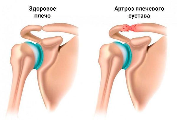 Симптомы плечевого артроза