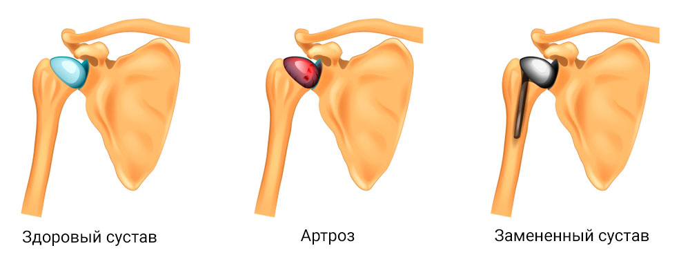 Эндопротезирование плечевого сустава при артрозе