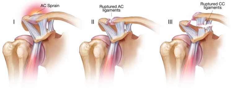 Стадии развития плечевого артроза