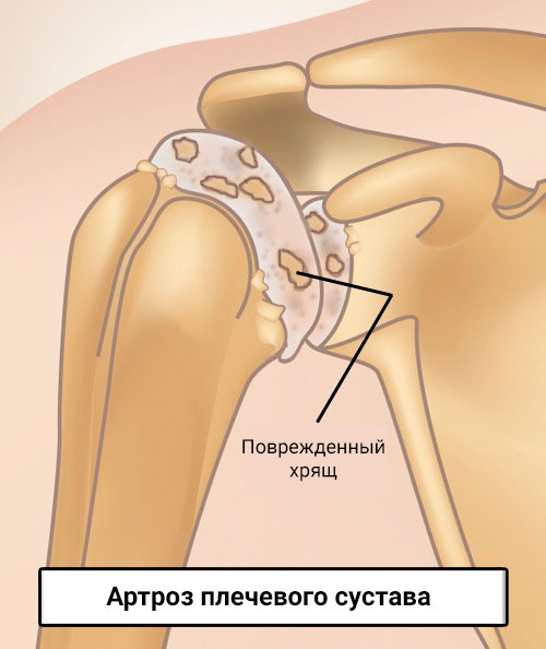 Основные методы лечения остеоартроза коленного сустава