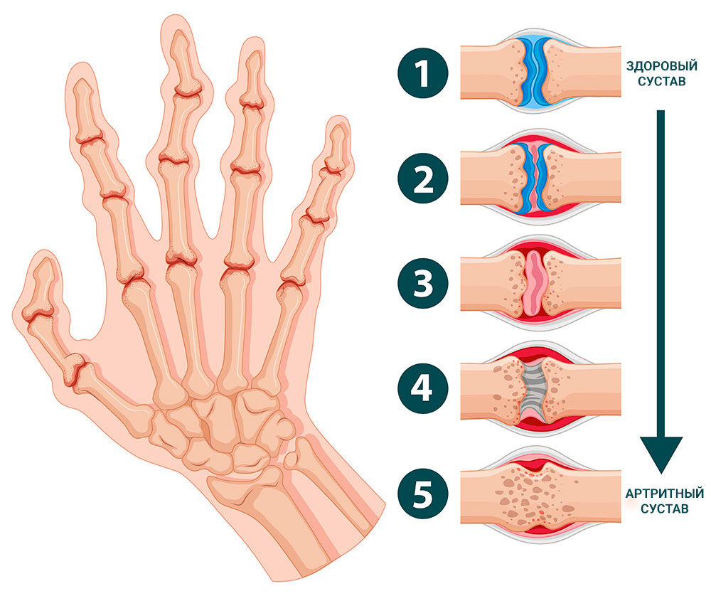 Стадии ревматоидного артрита кистей рук