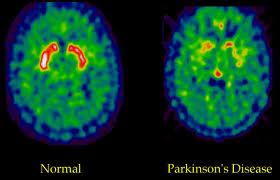 Лечение болезни Паркинсона лазерной терапией
