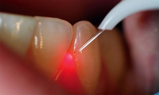 Лазер в стоматологии.jpg